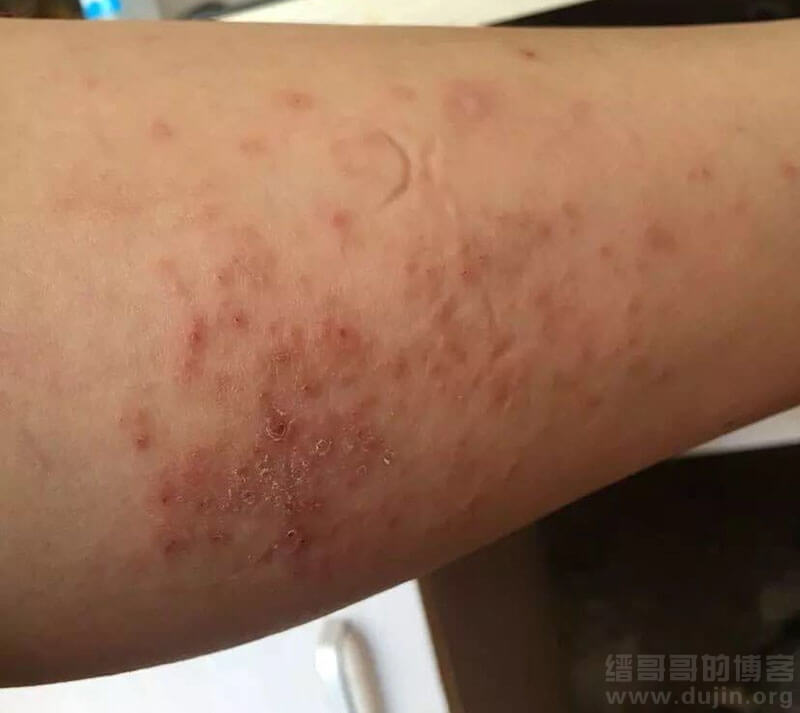 湿疹