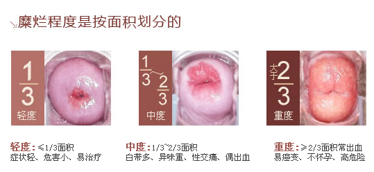宫颈柱状上皮异位(宫颈糜烂)分级诊断 宫颈柱状上皮异位(宫颈糜烂)分级诊断