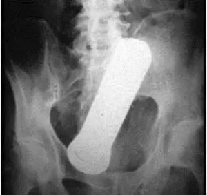 CT:卡在阴道内的手电筒 CT:卡在阴道内的手电筒