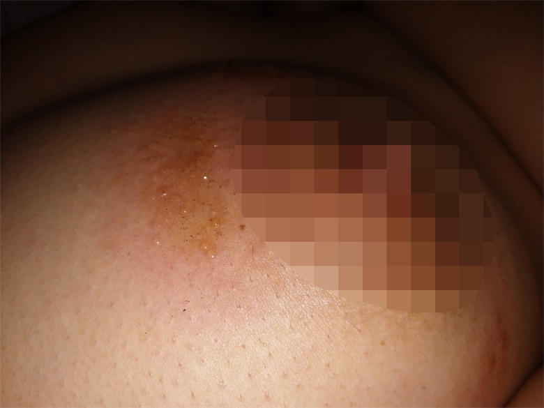 7月27日就诊是乳头上方的密集水泡,确诊为缠腰火丹(带状疱疹)。 7月27日就诊是乳头上方的密集水泡,确诊为缠腰火丹(带状疱疹)。