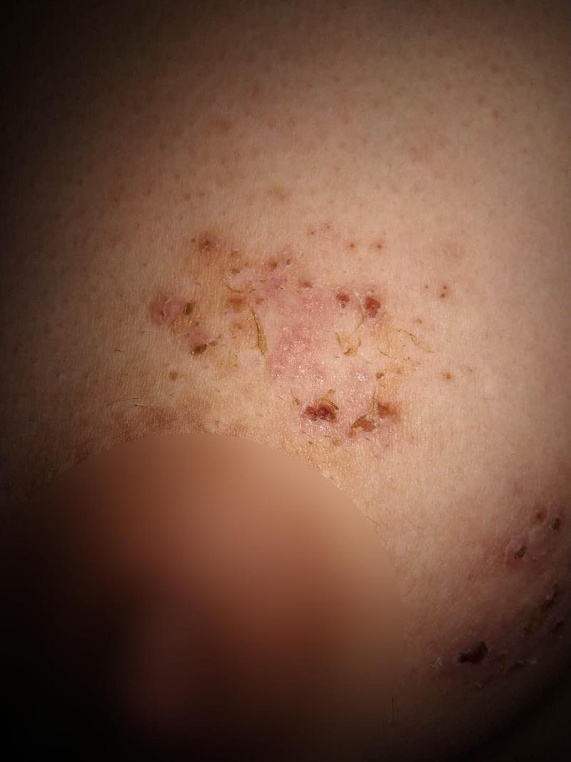 图为8月6日乳房上侧缠腰火丹(带状疱疹)结痂脱落,相比之前明显好转。 图为8月6日乳房上侧缠腰火丹(带状疱疹)结痂脱落,相比之前明显好转。
