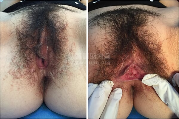 女性尖锐湿疣的病因与自我防御,及临床案例并了解HPV疫苗 女性尖锐湿疣的病因与自我防御,及临床案例并了解HPV疫苗