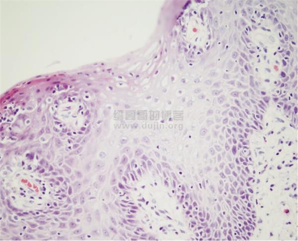女性尖锐湿疣的病因与自我防御,及临床案例并了解HPV疫苗 女性尖锐湿疣的病因与自我防御,及临床案例并了解HPV疫苗